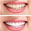 Triple Action Cosmetic Teeth Whitening (initial)